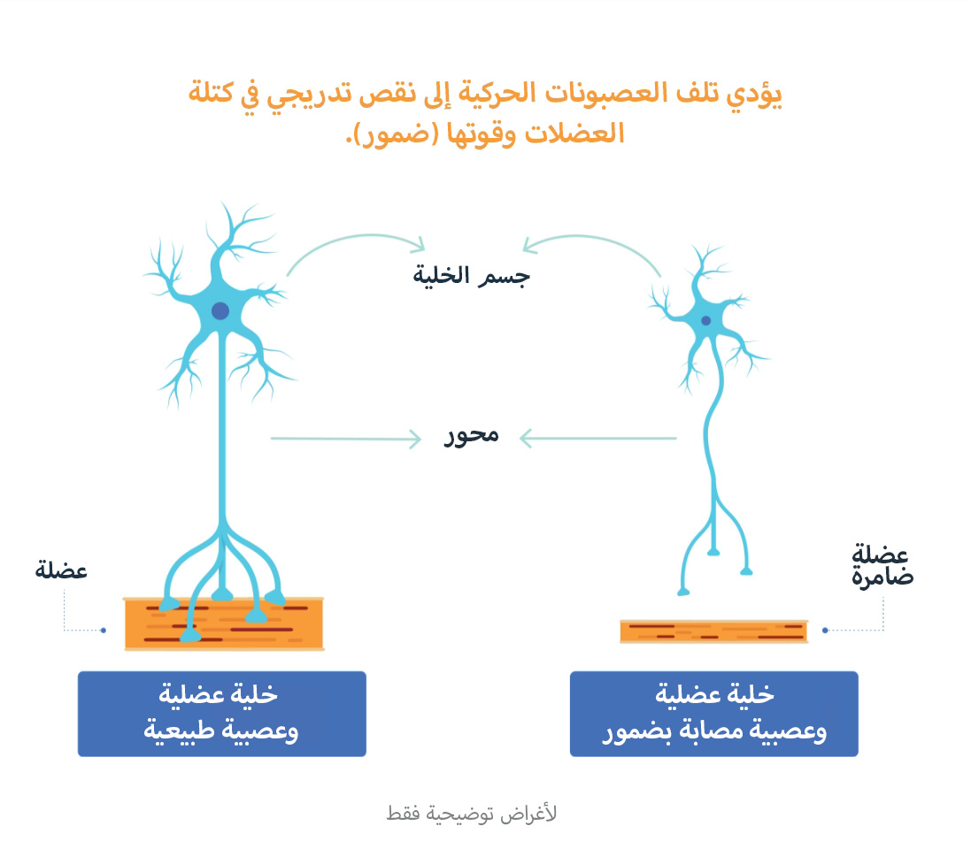 فهم سبب ضمور العضلات الشوكي - مخطط